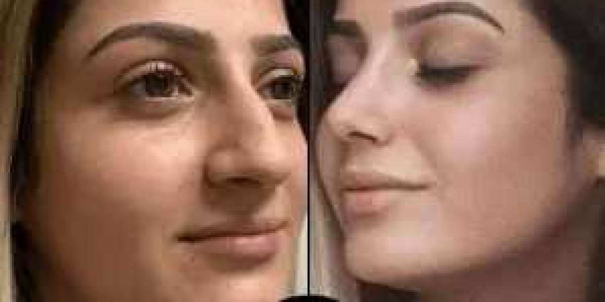 PRP Treatments in Dubai for Acne Scars and Fine Lines