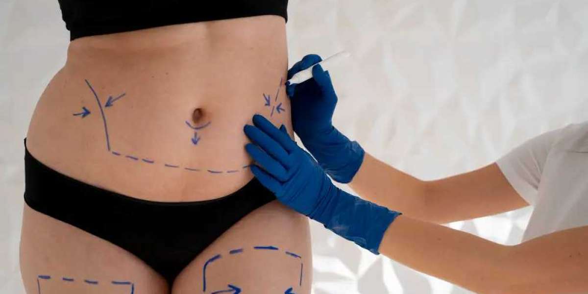 Liposuction for First-Timers: A Beginner’s Guide