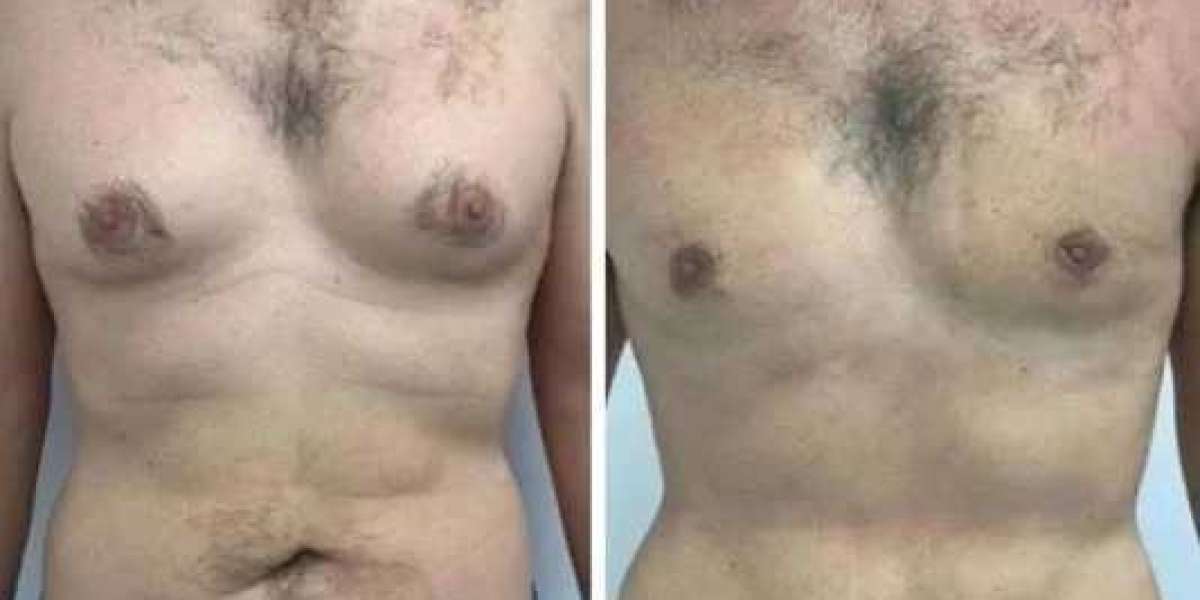 Gynecomastia Surgery in Dubai: Hormonal vs Glandular Causes