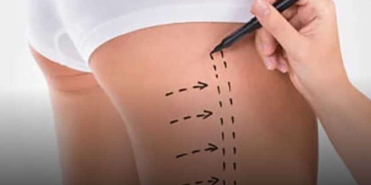 Expert Surgeons for Thigh Liposuction in Dubai