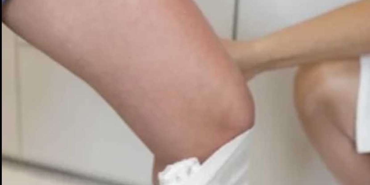 Knees Liposuction in Dubai Safe and Reliable Procedure